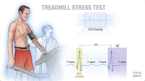 are exercise stress tests used in china